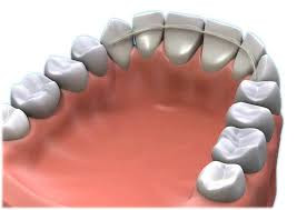 Imobilizarea dentara