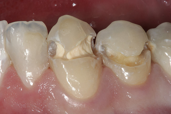 Cimenturile glassionomere cu antibiotice