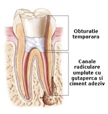 Materiale de obturatie provizorie