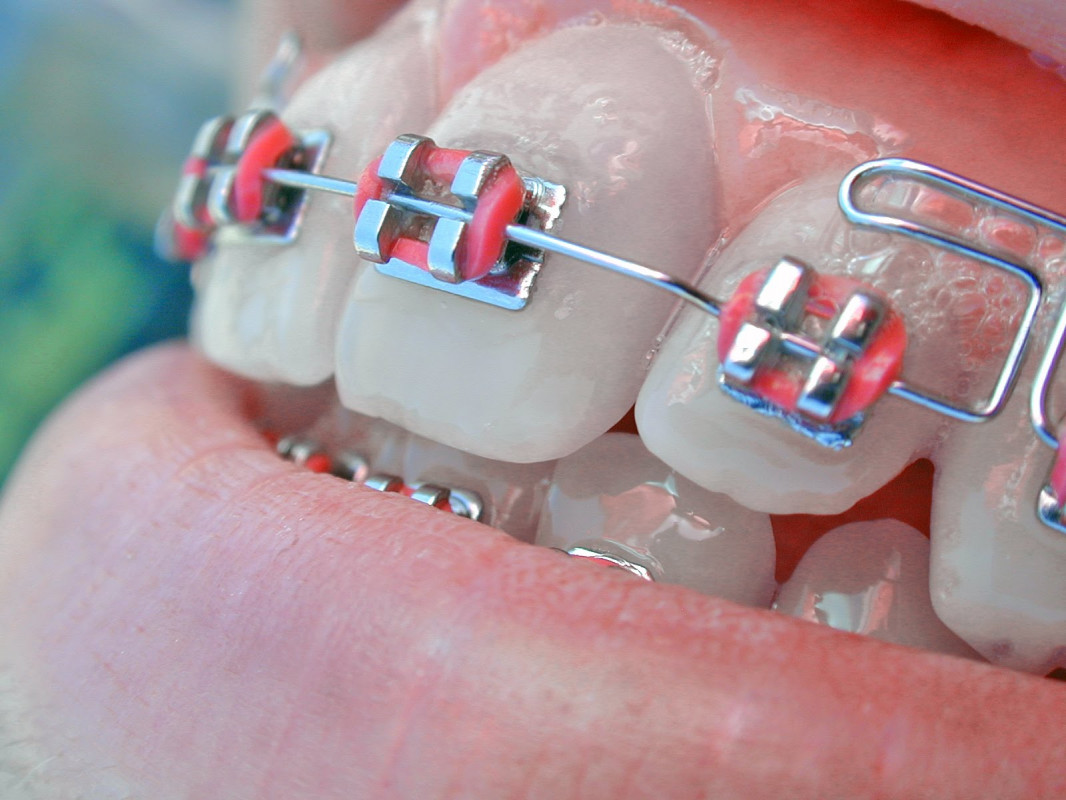 Istoria aparatelor dentare