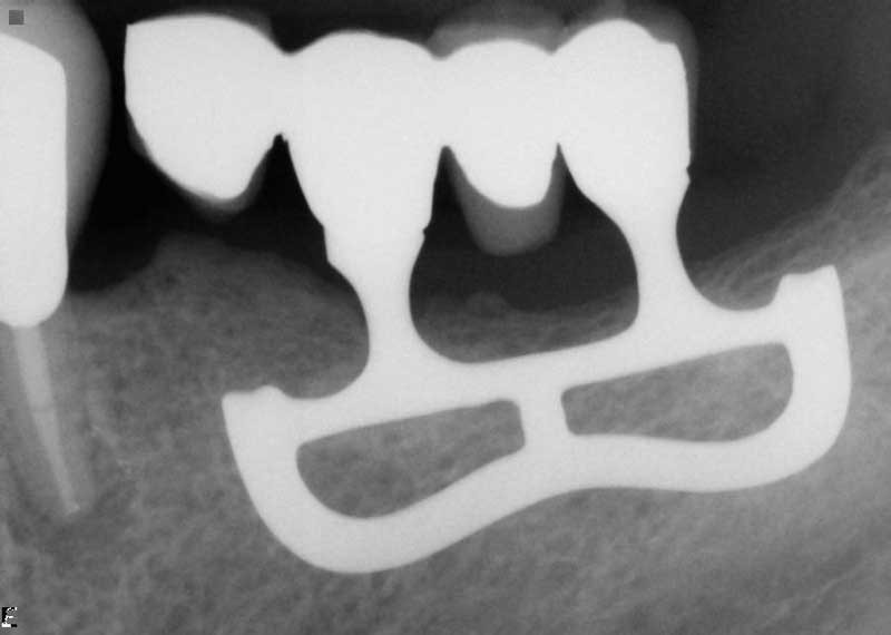 Tipuri de implante dentare