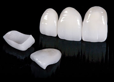Faţetele dentare fără preparaţie