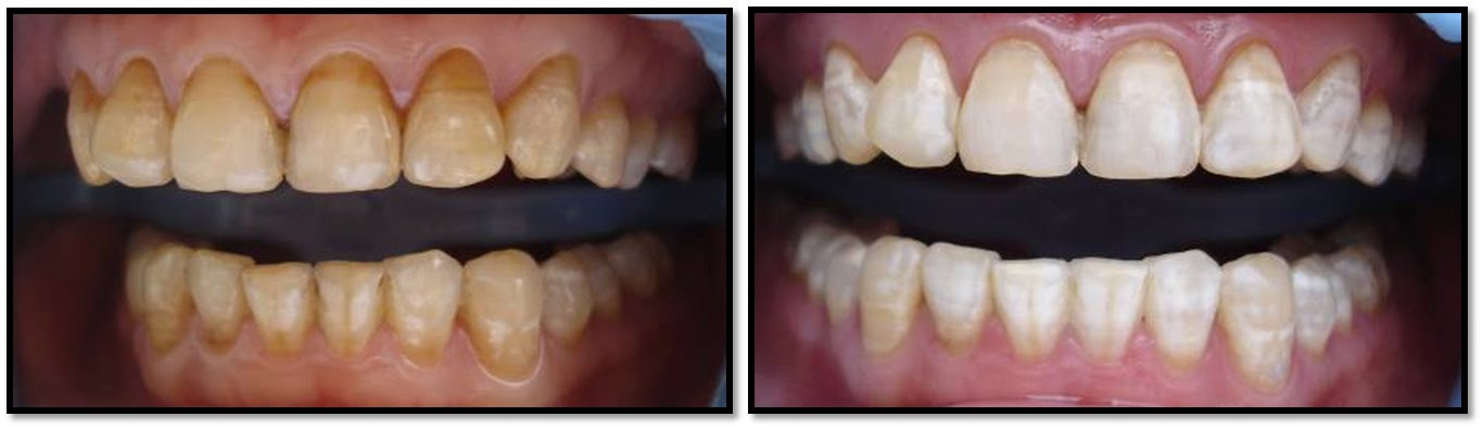 Tratamentul fluorozei dentare
