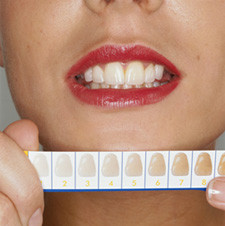 Cheia de culori dentare