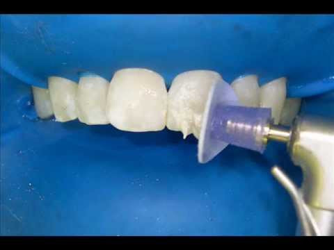Microabraziunea