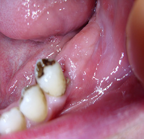 Ameloblastomul