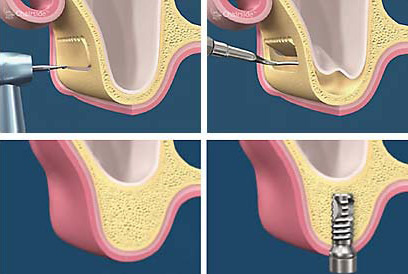 Sinus lifting