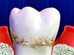 Tartrul dentar - cum apare și cum il putem combate?