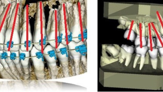 Aparatele dentare – răspunsuri de la A la Z