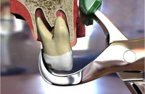 Extracţia dentară