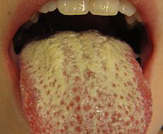 Candidoza bucala orala