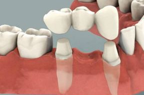 Puntea dentara