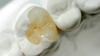 Ceramica vs compozit