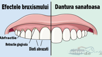 Tratament bruxism