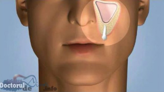 Sinuzita maxilara odontogena