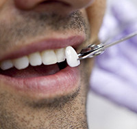 Care sunt indicatiile si contraindicatiile fatetelor dentare