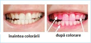 Controlul periajului dentar - revelatorii de placa