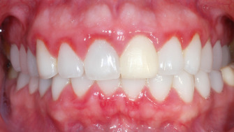 Efectele unui periaj dentar agresiv