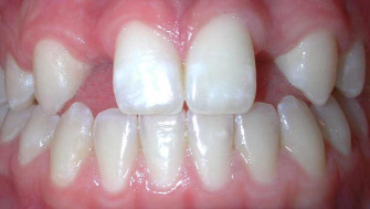 Anomalii dentare de numar