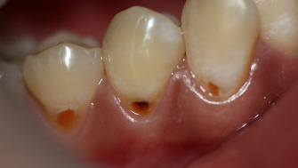 Eroziunea dentară