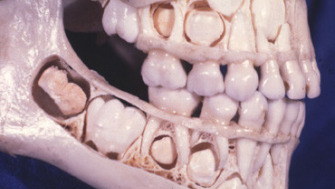 Fluoroza dentară