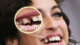 Sunt un candidat pentru implant dentar