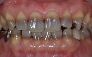 Tetraciclina si discromia dentara