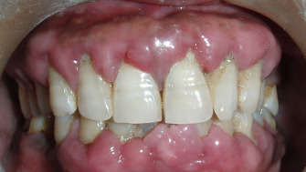 Cresterea anormala a gingiilor sau hiperplazia gingivala
