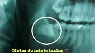 Incluzia dentara