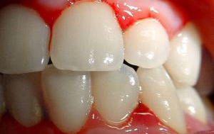 Tratamentul problemelor gingivale – remedii casnice