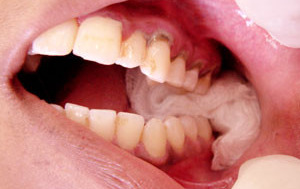 Hemoragia dupa extractia dentara