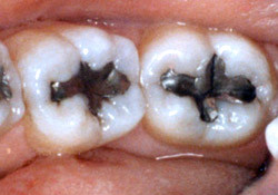 Cele mai folosite materiale de obturatie coronara