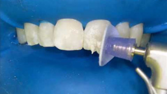 Microabraziunea