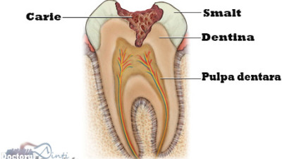 Primele semne ale cariei dentare
