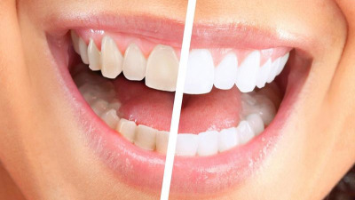 Cum prevenim ingalbenirea dintilor ?