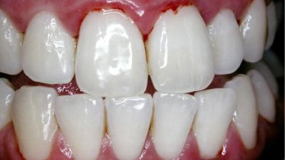 De ce îmi sângerează gingiile şi ce trebuie să fac