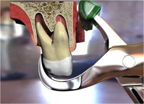 Extracţia dentară
