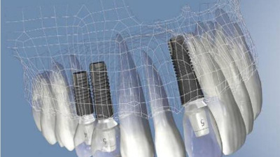 Intrebari despre un implant dentar