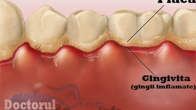 Placa bacteriana