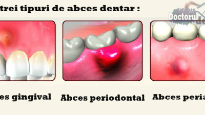 Abcesul dentar
