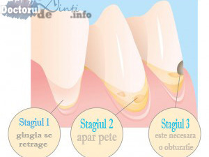 Tratamentul cariei dentare