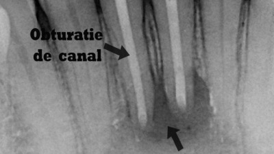 Chistul dentar (radicular)