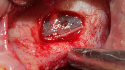 Curs perfecționare pentru medici: ”Sinus lift”