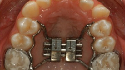Disjunctorul maxilar (palatinal)