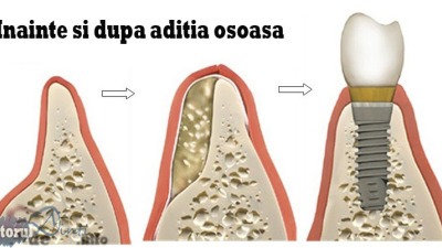 Aditia osoasa