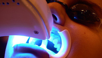 Cui se adreseaza albirea dentara