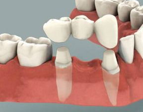 Puntea dentara