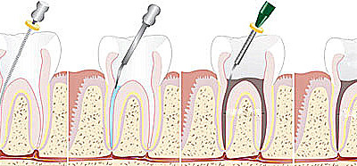 Tratamentul de canal endodontic