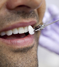 Care sunt indicatiile si contraindicatiile fatetelor dentare