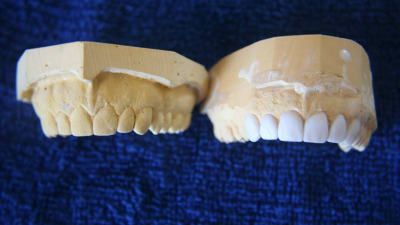 Wax-up-ul diagnostic